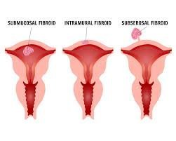fibroid symptoms and treatment in mumbai