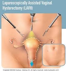 Types of Hysterectomy Surgeries