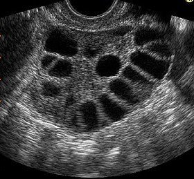 Polycystic Ovary Syndrome Treatment in Mumbai | PCOD Treatment in Mumbai