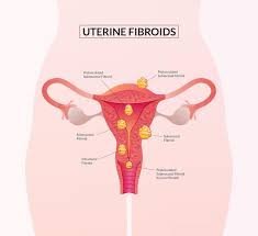 Fibroids Treatment in Mumbai | Expert Care At Naraya Health