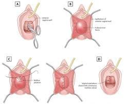 Types of Prolapse Surgery in Mumbai